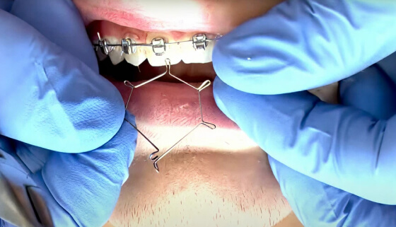 Orthodontics Products